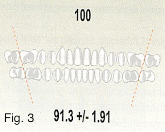 Understanding the Bolton Ratio Cheryl DeWood Understanding the Bolton Ratio Figure 3