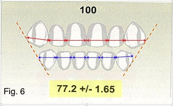 Understanding the Bolton Ratio Cheryl DeWood Understanding the Bolton Ratio Figure 6