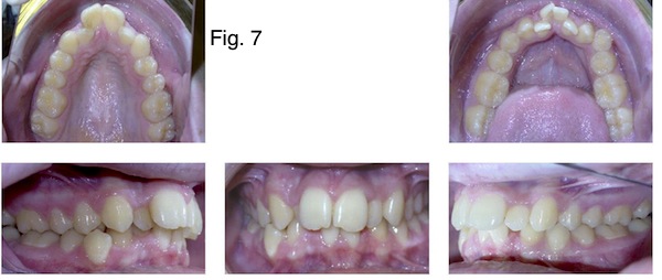 Understanding the Bolton Ratio Cheryl DeWood Understanding the Bolton Ratio Figure 7