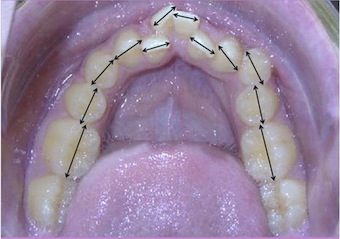 Understanding the Bolton Ratio Cheryl Dewood Understanding the Bolton Ratio Featured Image