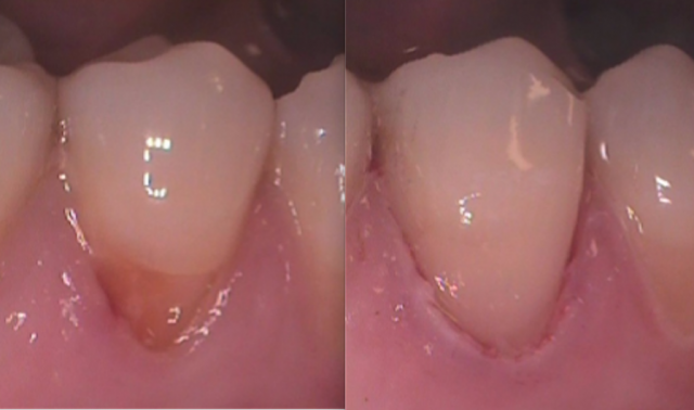 Four Products to Immediately Improve Your Composite Restorations Courtney Lavigne Four Products to Immediately Improve Your Composite Restorations Figure 2