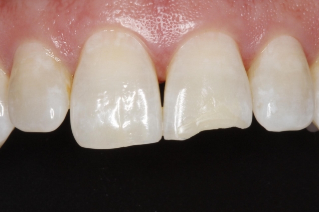 Four Products to Immediately Improve Your Composite Restorations Courtney Lavigne Four Products to Immediately Improve Your Composite Restorations Figure 4