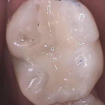 Courtney Lavigne dental composites figure 2