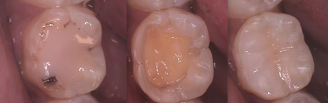 Courtney Lavigne dental composites figure 3