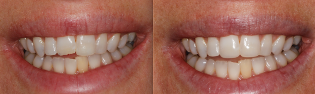 Courtney Lavigne dental composites figure 4