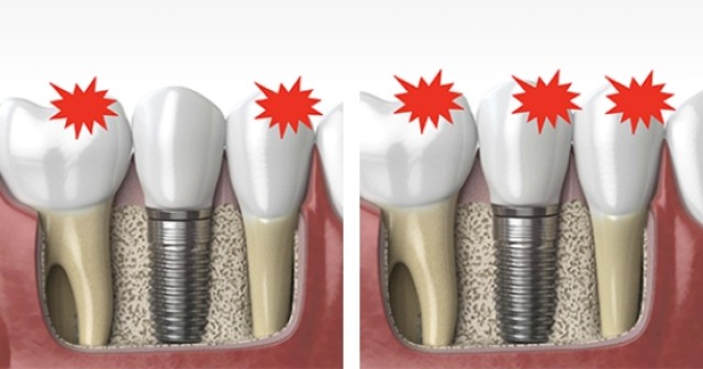 Curt Ringhofer Managing the Forces Occlusal Considerations with Implants Featured Image