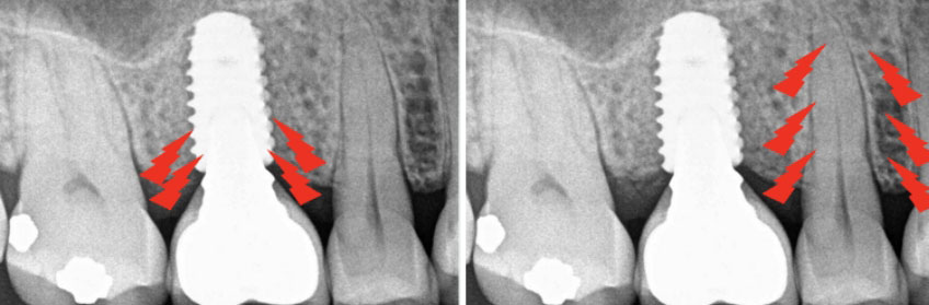 Curt Ringhofer Managing the Forces Occlusal Considerations with Implants Image 1
