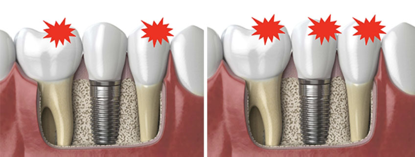 Curt Ringhofer Managing the Forces Occlusal Considerations with Implants Image 2