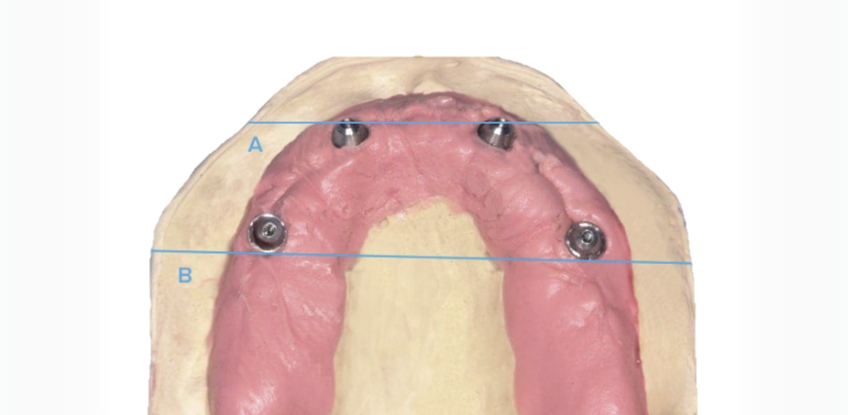 Curt Ringhofer Managing the Forces Occlusal Considerations with Implants Image 3