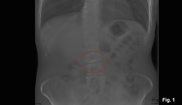 Accidental Ingestion of Dental Materials: Treatment and Prevention Treatment for accidental ingestion of dental materials