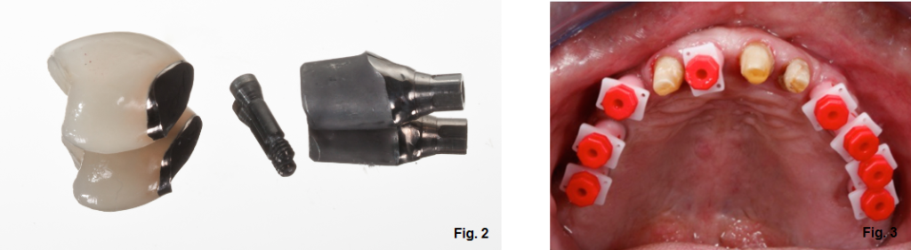 Accidental Ingestion of Dental Materials: Treatment and Prevention Darin Dichter Accidental Ingestion of Dental Materials Fig 2