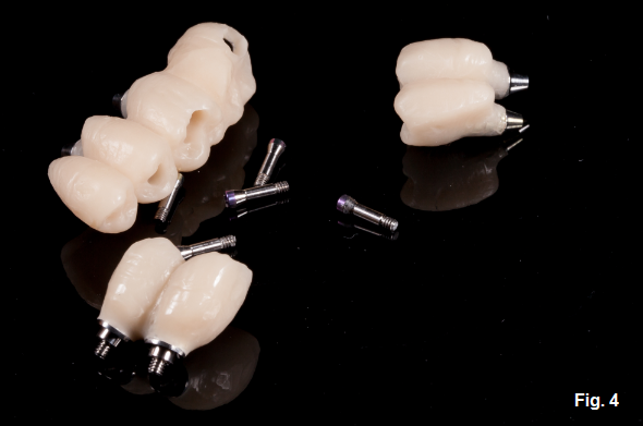 Accidental Ingestion of Dental Materials: Treatment and Prevention Darin Dichter Accidental Ingestion of Dental Materials Fig 3