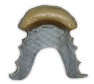 Conventional Complete Denture Fabrication in 9 Steps Darin Dichter Conventional Complete Denture Fabrication in 9 Steps Figure 2