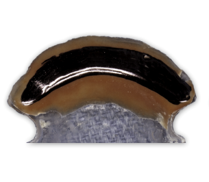 Conventional Complete Denture Fabrication in 9 Steps Darin Dichter Conventional Complete Denture Fabrication in 9 Steps Figure 3