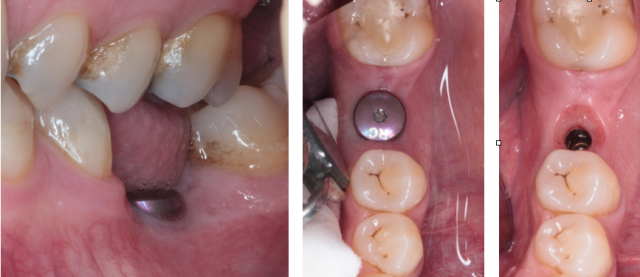 Reusing Titanium Healing Abutments Darin Dichter Reusing Titanium Healing Abutments Figure 1