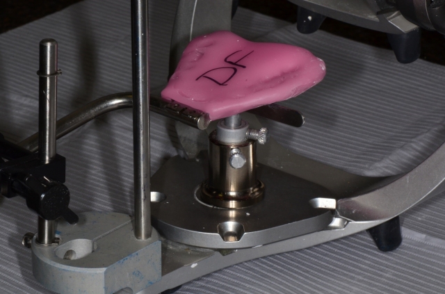 9 Steps to a Facebow Transfer Dave St Ledger 9 Steps to a Facebow Transfer Figure 13