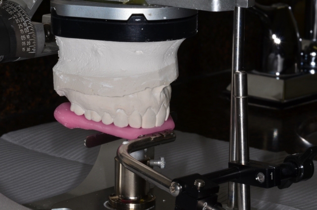 9 Steps to a Facebow Transfer Dave St Ledger 9 Steps to a Facebow Transfer Figure 14