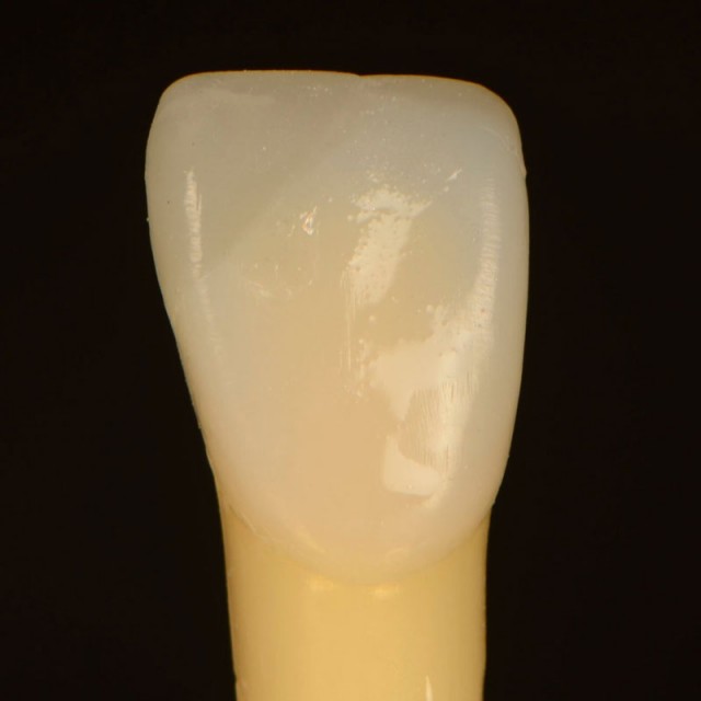 7 Common Problems with Layering Anterior Composites and How to Fix Them