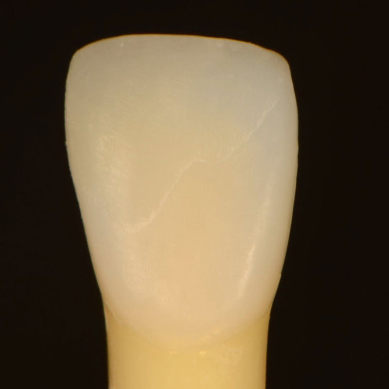 7 Common Problems with Layering Anterior Composites and How to Fix Them DawnWehking 7CommProbsLayeringAntComp Fig.10