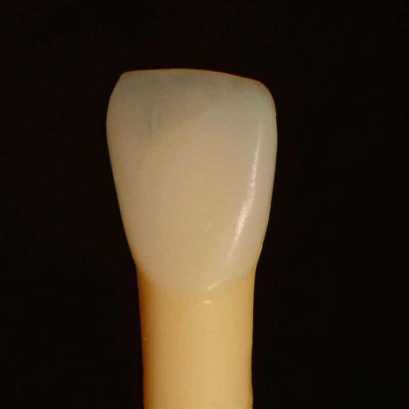 7 Common Problems with Layering Anterior Composites and How to Fix Them DawnWehking 7CommProbsLayeringAntComp Fig.11