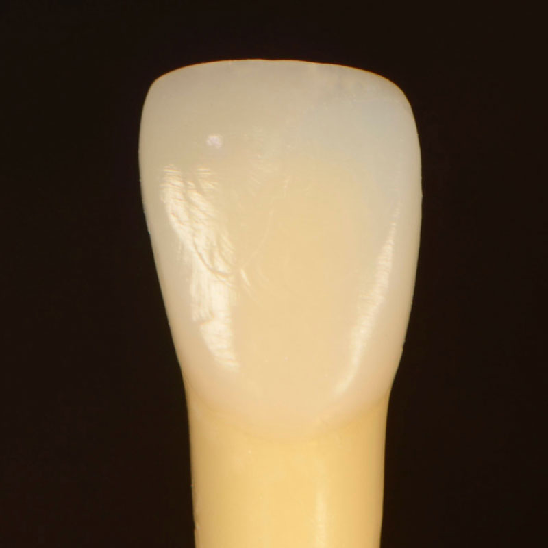 7 Common Problems with Layering Anterior Composites and How to Fix Them DawnWehking 7CommProbsLayeringAntComp Fig.12