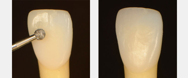 7 Common Problems with Layering Anterior Composites and How to Fix Them DawnWehking 7CommProbsLayeringAntComp Fig.13