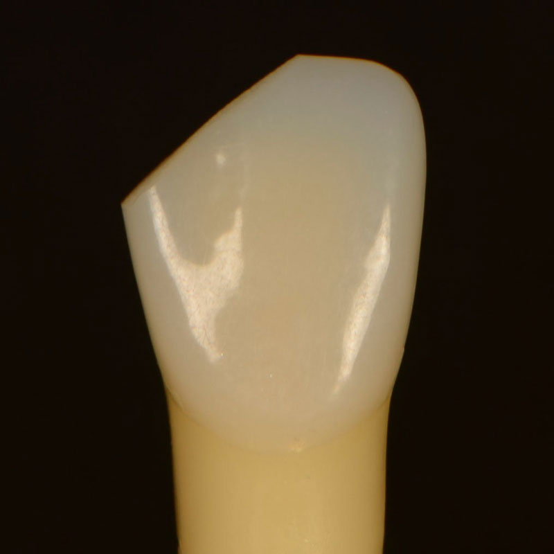 7 Common Problems with Layering Anterior Composites and How to Fix Them DawnWehking 7CommProbsLayeringAntComp Fig.2