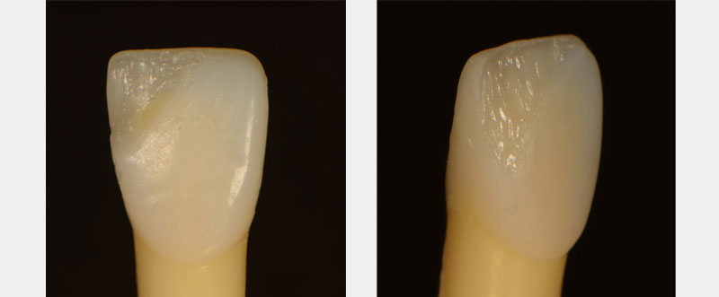 7 Common Problems with Layering Anterior Composites and How to Fix Them DawnWehking 7CommProbsLayeringAntComp Fig.4A 4B