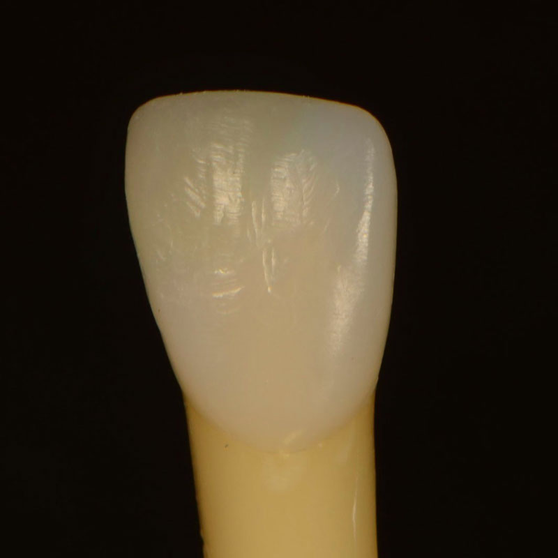 7 Common Problems with Layering Anterior Composites and How to Fix Them DawnWehking 7CommProbsLayeringAntComp Fig.5