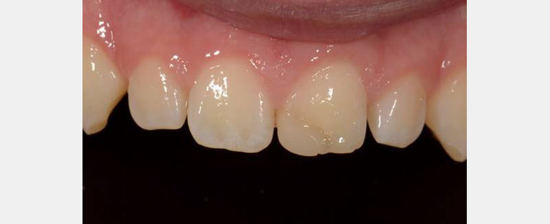 7 Common Problems with Layering Anterior Composites and How to Fix Them DawnWehking 7CommProbsLayeringAntComp Fig.7