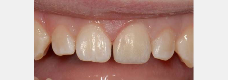 7 Common Problems with Layering Anterior Composites and How to Fix Them DawnWehking 7CommProbsLayeringAntComp Fig.8