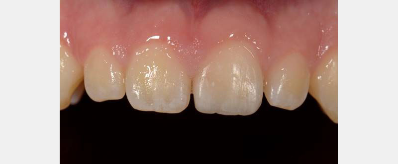 7 Common Problems with Layering Anterior Composites and How to Fix Them DawnWehking 7CommProbsLayeringAntComp Fig.9