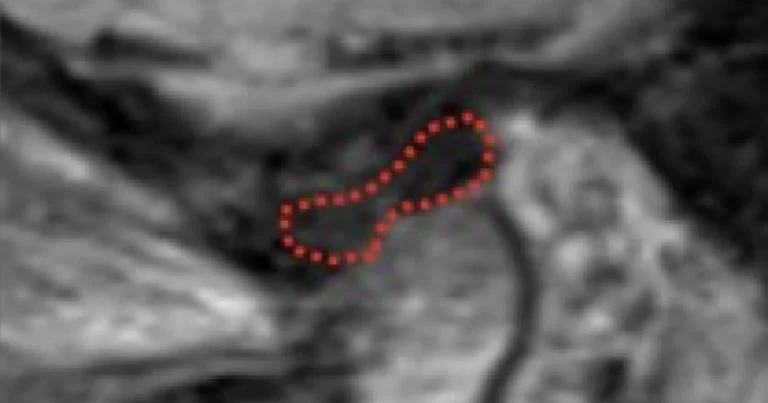 Spear Digest Diagnosing TMD Similarities Between Spears Occlusal Exam