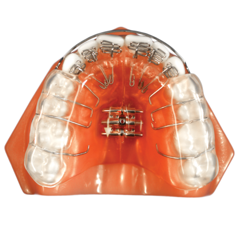 A Comparison of Orthodontic Retention Options Donna Stenberg A Comparison of Orthodontic Retention Options image3