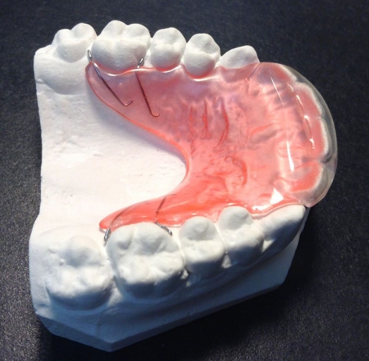 A Comparison of Orthodontic Retention Options Donna Stenberg A Comparison of Orthodontic Retention Options image5