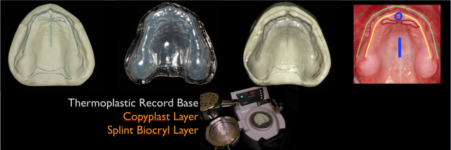 Three Techniques To Help Quick-Trigger Gag Reflex Patients Doug Benting Three Techniques to Help Quick Trigger Gag Reflex Patients Figure 3