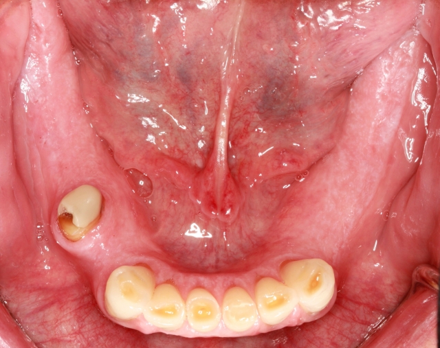 Three Techniques To Help Quick-Trigger Gag Reflex Patients Doug Benting Three Techniques to Help Quick Trigger Gag Reflex Patients Figure 5