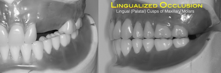 Lingualized Occlusion and the Edentulous Patient DougBenting LingualizedOcclusionEdentulousPatient Fig.1