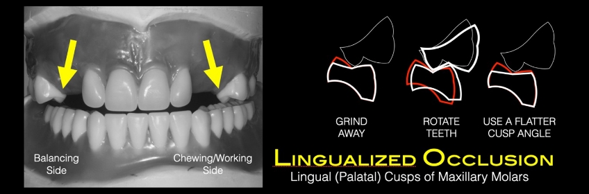Lingualized Occlusion and the Edentulous Patient DougBenting LingualizedOcclusionEdentulousPatient Fig.2