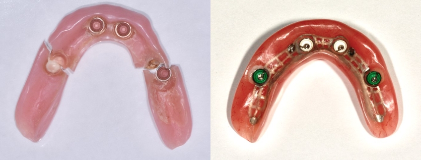 Novaloc Overdenture System: A New Approach To Low-Profile Attachments DougBenting Novaloc Overdenture System Fig.2