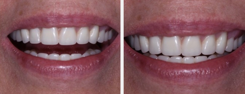 Novaloc Overdenture System: A New Approach To Low-Profile Attachments DougBenting Novaloc Overdenture System Fig.3