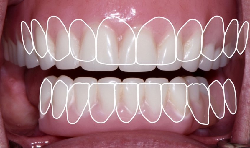 Novaloc Overdenture System: A New Approach To Low-Profile Attachments DougBenting Novaloc Overdenture System Fig.4