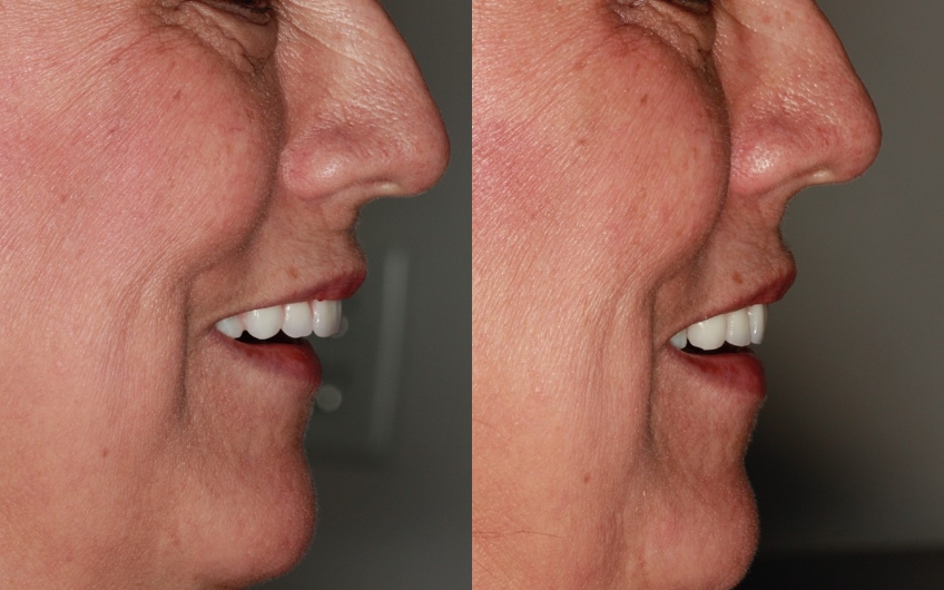 Novaloc Overdenture System: A New Approach To Low-Profile Attachments DougBenting Novaloc Overdenture System Fig.5