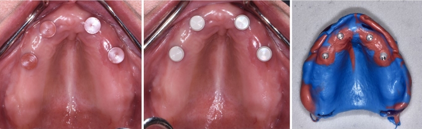 Novaloc Overdenture System: A New Approach To Low-Profile Attachments DougBenting Novaloc Overdenture System Fig.6