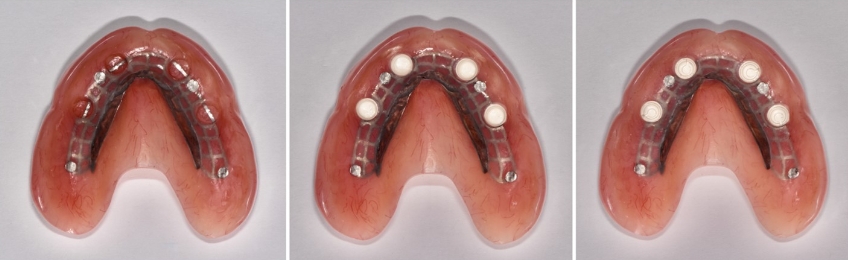 Novaloc Overdenture System: A New Approach To Low-Profile Attachments DougBenting Novaloc Overdenture System Fig.7