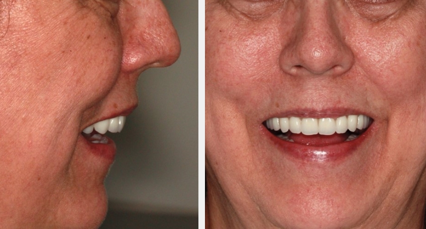 Novaloc Overdenture System: A New Approach To Low-Profile Attachments DougBenting Novaloc Overdenture System Fig.8