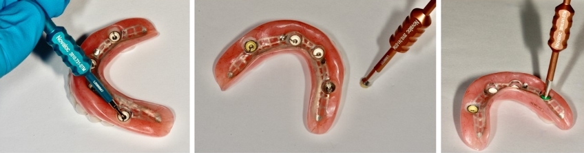 Novaloc Overdenture System: A New Approach To Low-Profile Attachments DougBenting Novaloc Overdenture System Fig.9