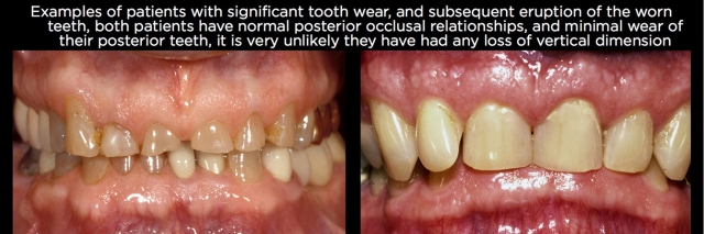 Managing Over-Eruption Following Tooth Wear Frank Spear Managing Over eruption Following Tooth Wear Figure 1