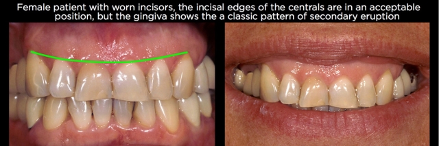Managing Over-Eruption Following Tooth Wear Frank Spear Managing Over eruption Following Tooth Wear Figure 10