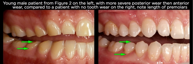 Managing Over-Eruption Following Tooth Wear Frank Spear Managing Over eruption Following Tooth Wear Figure 11